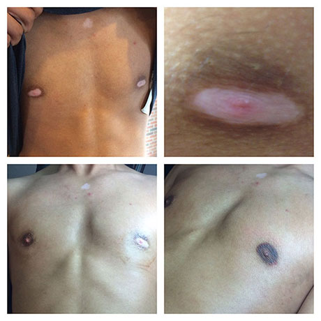 Areola Pigmentation for Men - Ohio